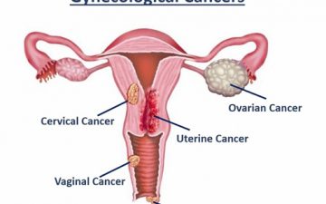 Gyne cancer